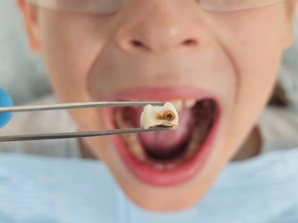 Best Emergency Wisdom Teeth Removal in Boyertown, PA